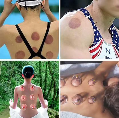 Set van 12 Massagecups - Verlicht spier en gewrichtspijn